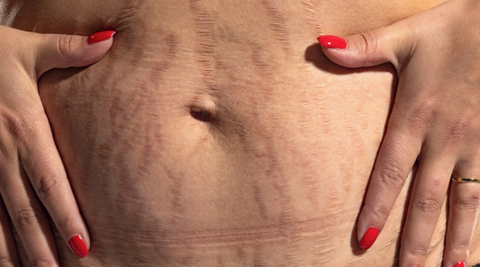 Huile vergeture grossesse : quels produits choisir et comment les utiliser ?